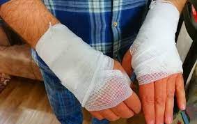 پاورپوینت سوختگی و اقدامات پرستاری